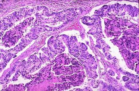 Metastase til uterus Carcinom kun i serosa og/eller myometrium? Dersom endometrium/-cervix Bevarte benigne kjertler? In-situ lesjoner?