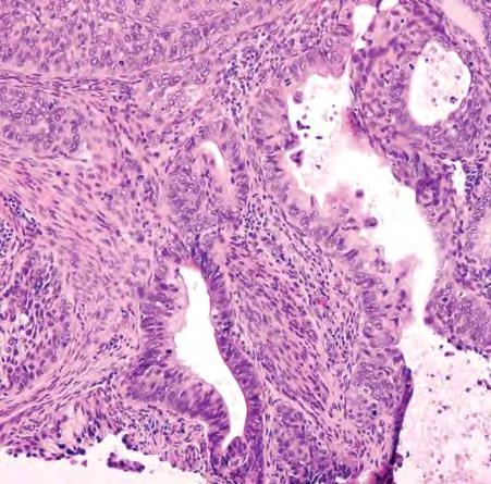 Differensialdiagnoser Adenoid basal hyperplasi Overfladisk (<1 mm) Horisontal utbredelse Adenoid cystisk carcinom Solid variant!