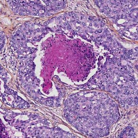 Adenoid Cystisk Carcinom Cribriformt Karakteristisk PAS+