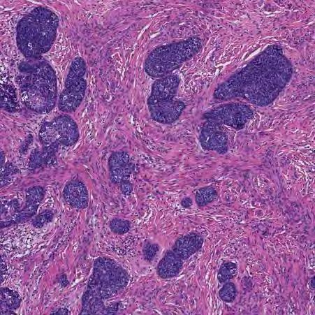 Differensialdiagnoser Adenoid basalt carcinom