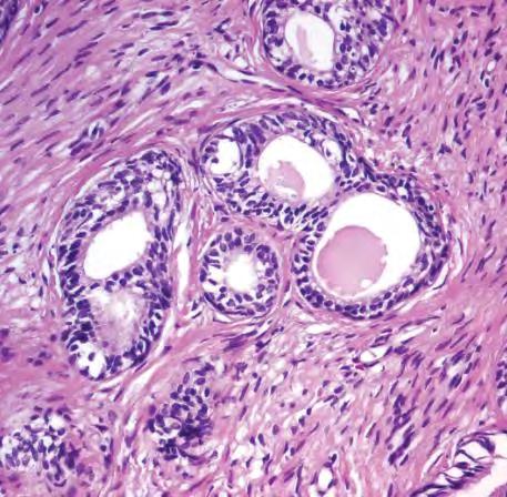 Differensialdiagnoser Adenoid basalt carcinom Eldre kvinner Basaloid Ofte