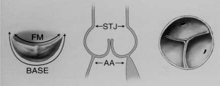 Реконструктивна хирургија на аортен корен Аортна инсуфициенција Аортна стеноза