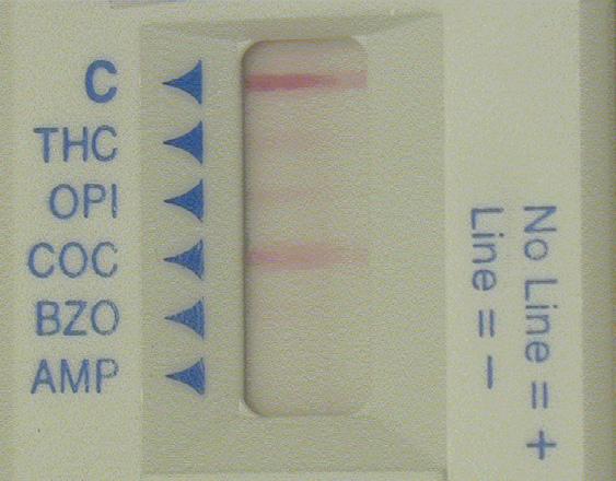 Hurtigtester Avlesning Avleser 1; BZO = positiv Avleser 2; BZO = negativ Kromatografisk analyse BZO = positiv