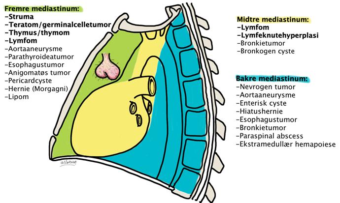 Diagnostikk Blodprøve Kan være til hjelp dersom man mistenker germinalcelletumores (AFP,