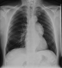 Oppsummering Oppfylninger i mediastinum kan være både en diagnostisk og terapautisk utfordring jf.