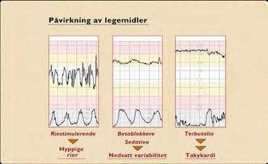 Rask utvikling av hypoksi Parasympaticus: Vagus Bradykardi Rask