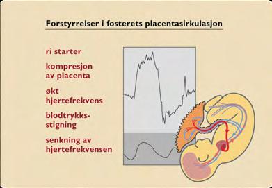 (volum volumreseptor ) HON EH. The electronic evaluation of the fetal heart rate. Preliminary report. 1958.