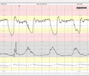 Bennet L, Westage J et al J Appl Physiology 2005 1 min / 2,5 min Gradvis hypotensjon (8KVD/20 min) BT fall etter