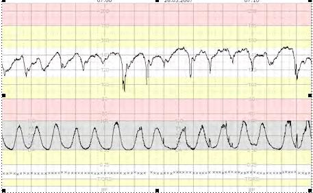 Total deceleration area was most discriminative of acidemia (AUC=0.76; 95% CI: 0.72-0.