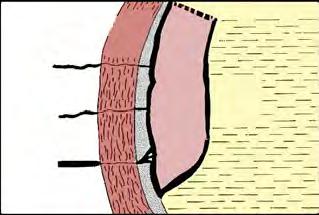 Rier: effekten på sirkulasjonen Uterin hypertoni (tachysystoli): Myometrium: 2-3 ganger Intrauterin trykk Intervillous rom >5 kontraksjoner/10 min