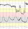 deoxihemoglobin Det må 2,3 min mellom kontraksjoner for a unngå signifikat oksygenfall i hjerne!