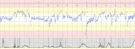 V. et al (2008). BJOG, 115(9), 1101 1107. Wolf, H. et al. (2016). Ultrasound in Obstetrics & Gynecology (50) 71-78 Ikke normal CTG - hva så?