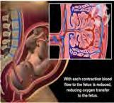 Kardiovaskulær Senter i medulla Foster hjertemuskel Foster hjerte frekvens Navlesnor Young BK AJOG 1980 Hypoksemi Hypoxemia: reduced oxygen in blood Hypoxia: reduced oxygen supply