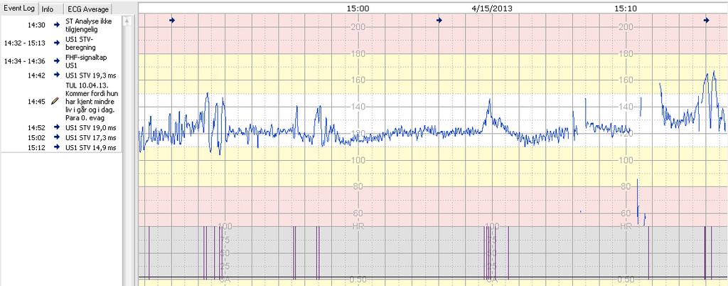 Auskultasjon - hva kan vi lytte? N=3 jordmødre vs.