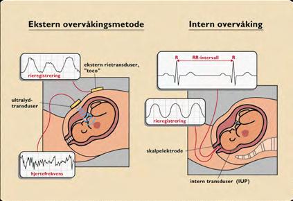 Diferensiering er mangefult Risikofaktorer hos mor: Risikofaktorer hos foster: Risikofaktorer under fødsel: Preeklampsi Preterm fødsel ( <37 SU) Stimulering med oxytocin (CTG) Etter vurdering STAN