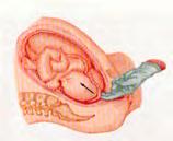 undersøkelse: sjekke reaktivitet Fetal stimulasjon: stimulere det autonom nerve systemet og fremkalle akselerasjoner. Pålitelig møte å ekskludere acidose!