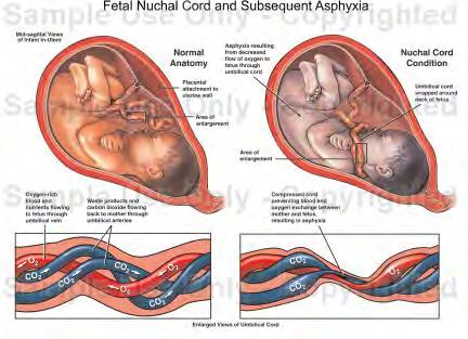 Syre-base status ph pco 2 Base Deficit Ductus venosus Umblical vein Umblical artery ph i navlearterie < ph i vene pco 2 i navlearterie > pco 2 i vene Syre-base status ph og pco 2 BDecf= 0.9149 (0.