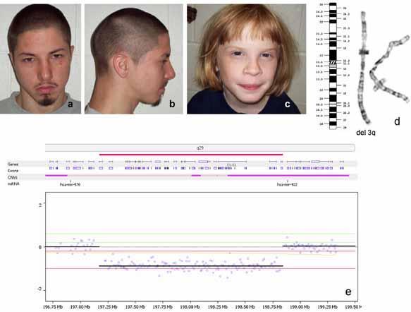 3q29 mikrodelesjoner og mikroduplikasjoner