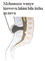 menopose: ukomahedhi: kupindi ambacho mwanamke huacha kupata hedhi ambacho kwa kawaida huanzia umri wa miaka 50 na meningocele: meningoseli: aina kuendelea.