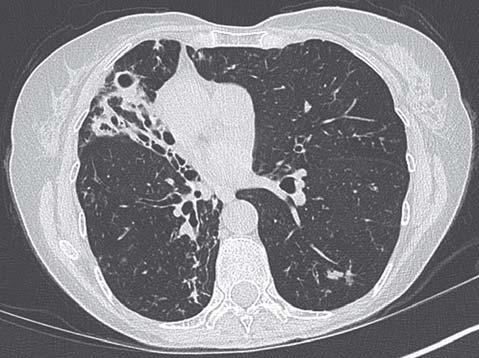 hemoptyse, brystsmerter, kvalme Uspesifikke kliniske funn Radiologiske funn: Avhenger av tidligere sykdom Fibrokavitær (som ved Tb)