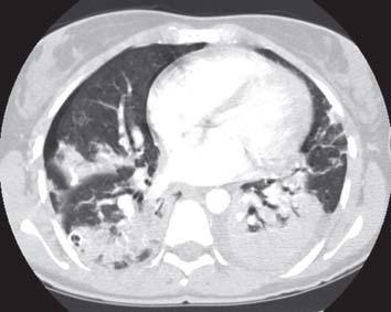 «Hot tub lung» Klinikk og diagnostisering lunger Klinikk og radiologiske funn!! Mikrobiologisk diagnostikk: Obs. kontaminering En pos.