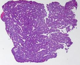 polypøse neoplasmer i øregang Se på cellesammensetning i stroma Proliferasjon av granulasjonsvev med