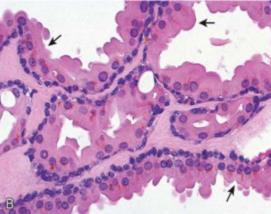 klassifikasjon Ceruminøst adenom Ceruminøst pleomorft adenom Syringocystadenoma papilliferum Ceruminøst