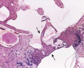 Lokaldestruktiv non neoplastisk lesjon i mellomøre og mastoid Kan være kongenital, ellers sekundært til otitis media Radiologi: ofte