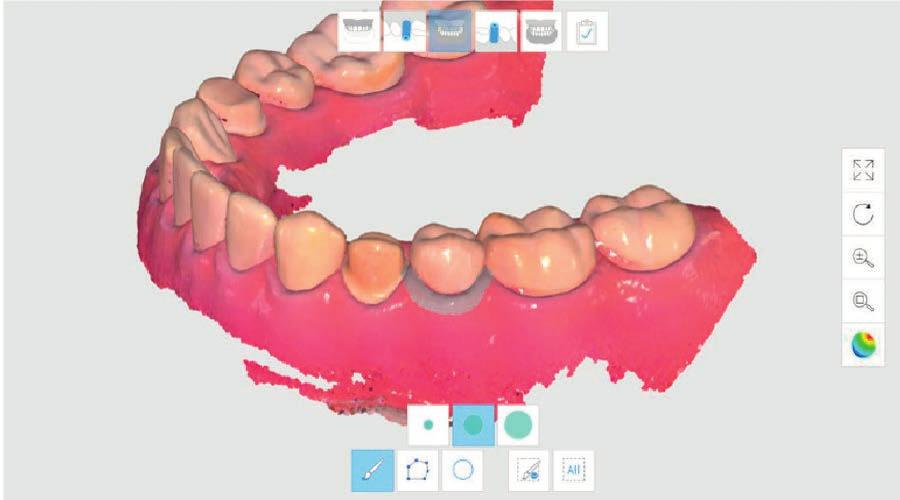 fiksere retrahert gingiva rett