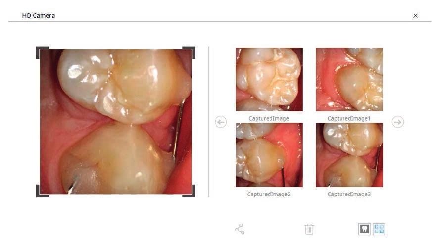 gingiva kan falle tilbake.