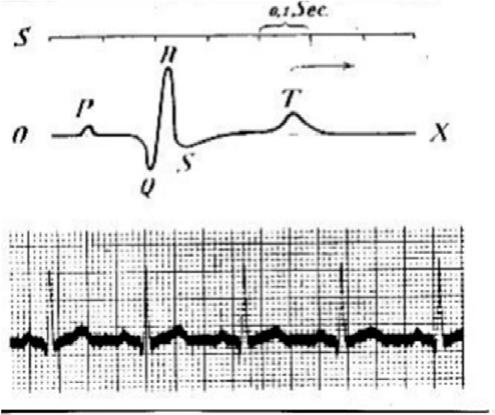 Figur 8. Medtronics første «fabrikk» Figur 6. Einthovens første EKG-registreringer nål stukket inn i hjertet. Det er ikke klart om den noen gang ble brukt på mennesker.