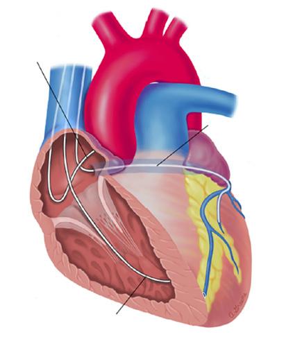 stimulere der, samtidig med simultanstimulering med ledningen i høyre hjertekammer, for å resynkronisere hjertekamrene.