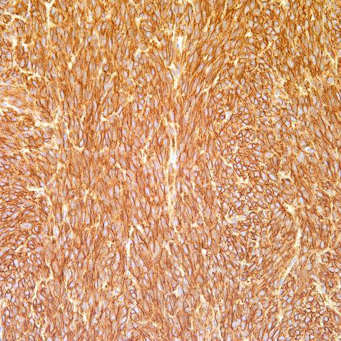 CD34, CD 117, Cytokeratin