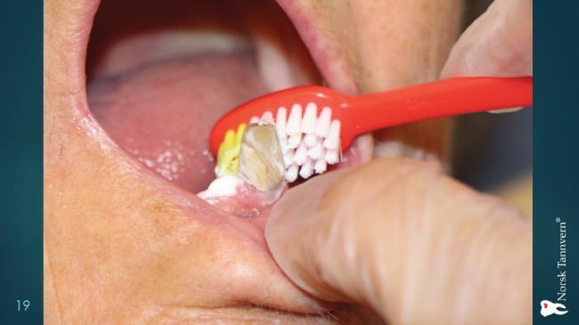 3. Pasienter med egne tenner og proteser: Mål Renholdet av tenner og protese skal opprettholdes slik at ikke flere tenner går tapt. Utstyr Liten myk tannbørste (evt.