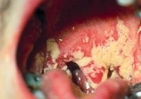 Soppinfeksjon Soppinfeksjon er en svært smertefull tilstand som kommer lett dersom munnhygienen uteblir, ved antibiotikabehandling, enkelte