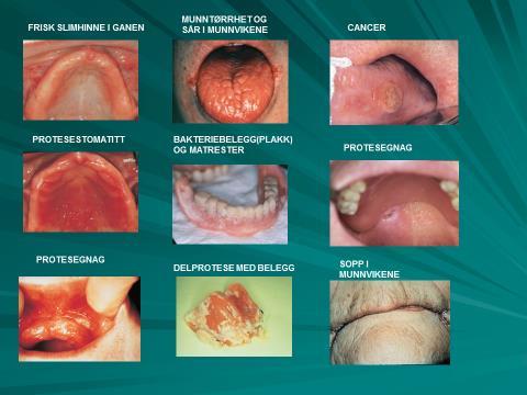 Kontakt tannhelsetjenesten dersom det er mistanke om protesegnag, sår i munnen eller annen infeksjon.