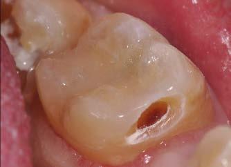 Karies Fakta Karies Karies er en bakteriesykdom som kan forårsake det som på folkemunne gjerne omtales som hull i tennene.
