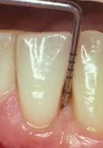 Periodontitt Fakta Periodontitt. Er en betennelsessykdom som rammer tennenes feste. Dersom sykdommen ikke behandles, kan tennene bli løse og risiko for å miste tennene øker.