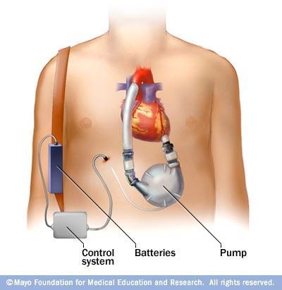 Kunstig hjerte LVAD Left ventrcular assist devices