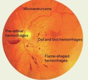 Retinopati og systematisk øyeundersøkelse ved diabetes diabetes type 1 henvises til øyelege fem år etter diagnosetidspunkt diabetes type 2 henvises til øyelege ved