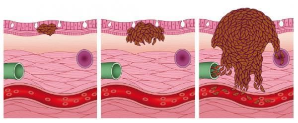 Årsak til melanoma - sola