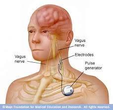 Vagus nerve stimulator (VNS) Fordeler: Effekt både på fokale og generaliserte anfall Liten operasjon