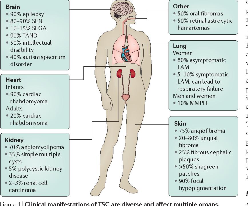 Tuberøs sklerose (TS) Vekst av godartede svulster i