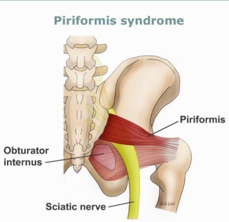 Arbeidsprofil Har et arbeid som medfører føttene invertert eller rett frem vil øke belastningen på M. piriformis. Sittende arbeid på for mykt eller ergonomisk feil stol eller underlag. 11.1.3.