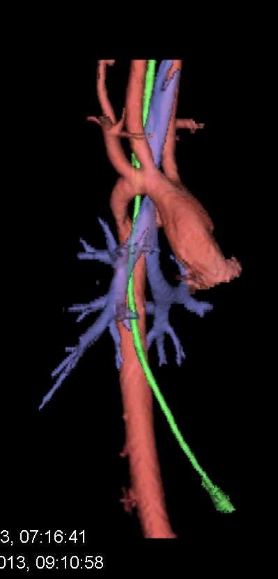 persisterende lungeinfiltrater Lungelesjon av ukjent årsak