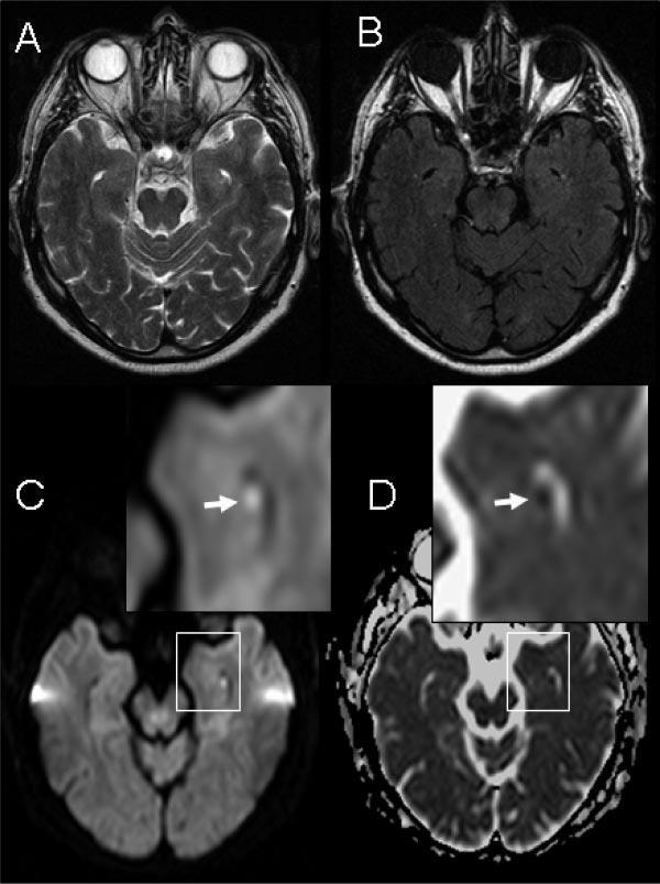 Figure 1. Typical DWI lesion in a TGA patient. Representative axial slices from a 66-year-old male TGA patient (time interval between clinical onset and imaging was 20 hours).