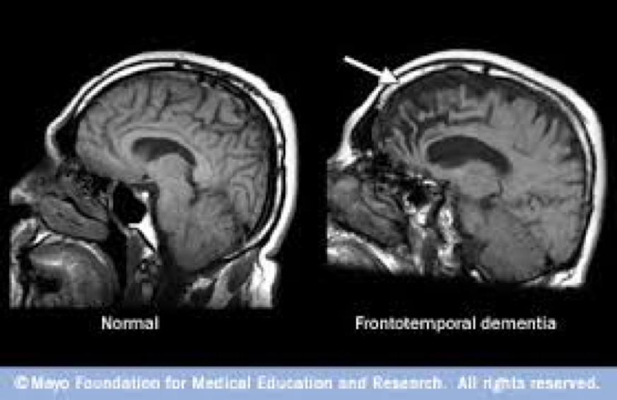 Frontotemporallappsdemens (FTLD) (McKhann kriterier) Tidlig innsettende og progredierende personlighetsendringer Tidlig tap av innsikt