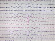 Epilepsi er en av de vanligste