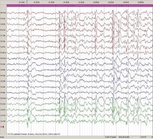 epilepsien og den bakenforliggende sykdommen bidrar til forsinket utvikling