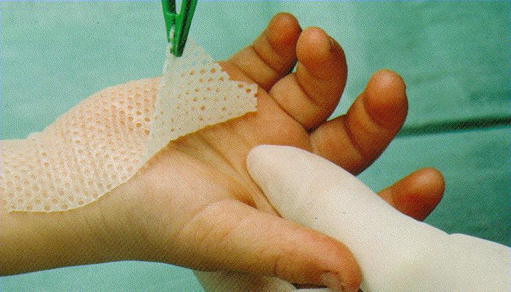 Lite heftende bandasjer Lages ved hjelp av ulike produkter som ikke hefter/hefter lite i såret, som vaselinkompress, silikon, plast, kunststoff. Primær og sekundærbandasje.
